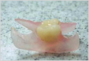 Acrylic flipper partial made at Esthetic Designs dental lab